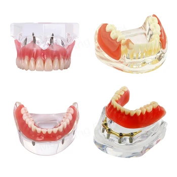 Стоматологическая модель со съемными и восстанавливаемыми зубами Образовательная стоматологическая модель Имплантация зубов с протезированием для медицинских исследований